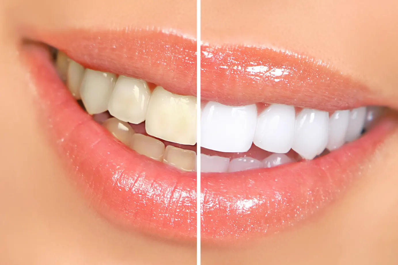 Teeth Whitening schaumburg